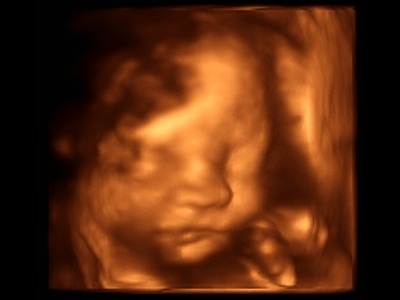 obrázek 3D ultrazvuk