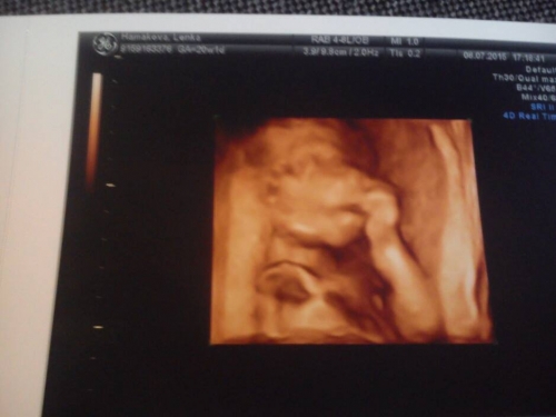 obrázek ultrazvuk 20.týden 3.D