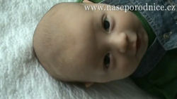video Fontanela - vazivové spojení na hlavě novorozence
